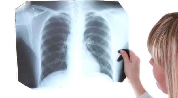 Lung x-ray